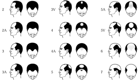 Hair Loss Pattern